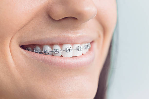 Dental Inlays and Onlays in Claremont, CA